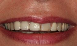 Smile with unusually short teeth