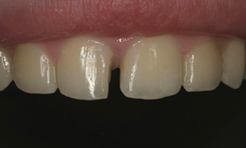 Close-up of gap between upper front teeth