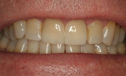 Smile after treatment with no black lines