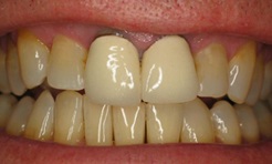 Smile before treatment with black lines around upper front teeth
