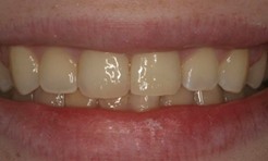 Teeth after being restored