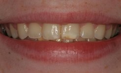 Damaged teeth prior to treatment