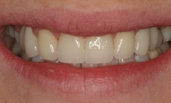 Completed smile with restored dental implants