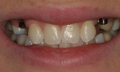 Smile with missing teeth and visible dental implants