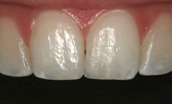 Close-up of formerly chipped tooth that was repaired