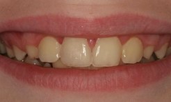 Close-up of teeth after damage has been repaired