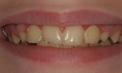 Close-up of misshapen and worn down teeth