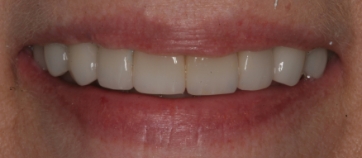 After Smile