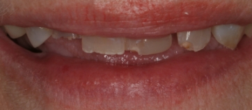 Before Smile