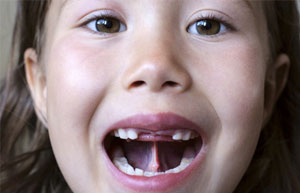 child’s lingual frenulum