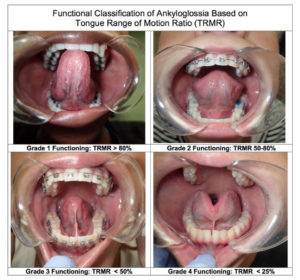 Functional classification of tongue tie symptoms.