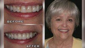 Patient transformations displaying before and after photos of a woman's teeth.