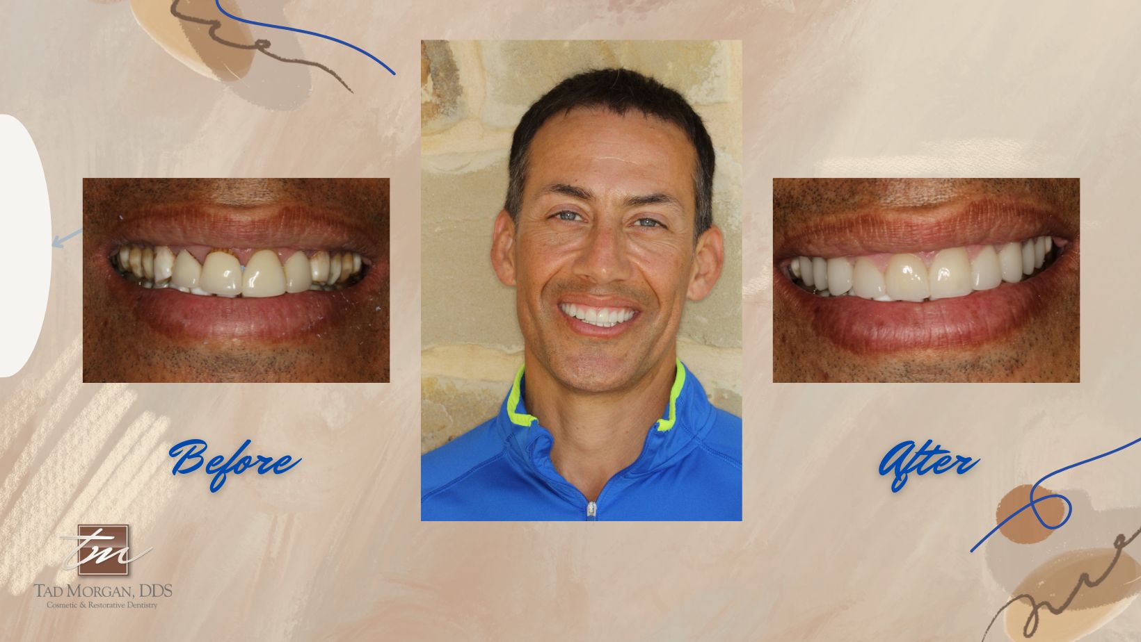 Before and after photos of a man's teeth.