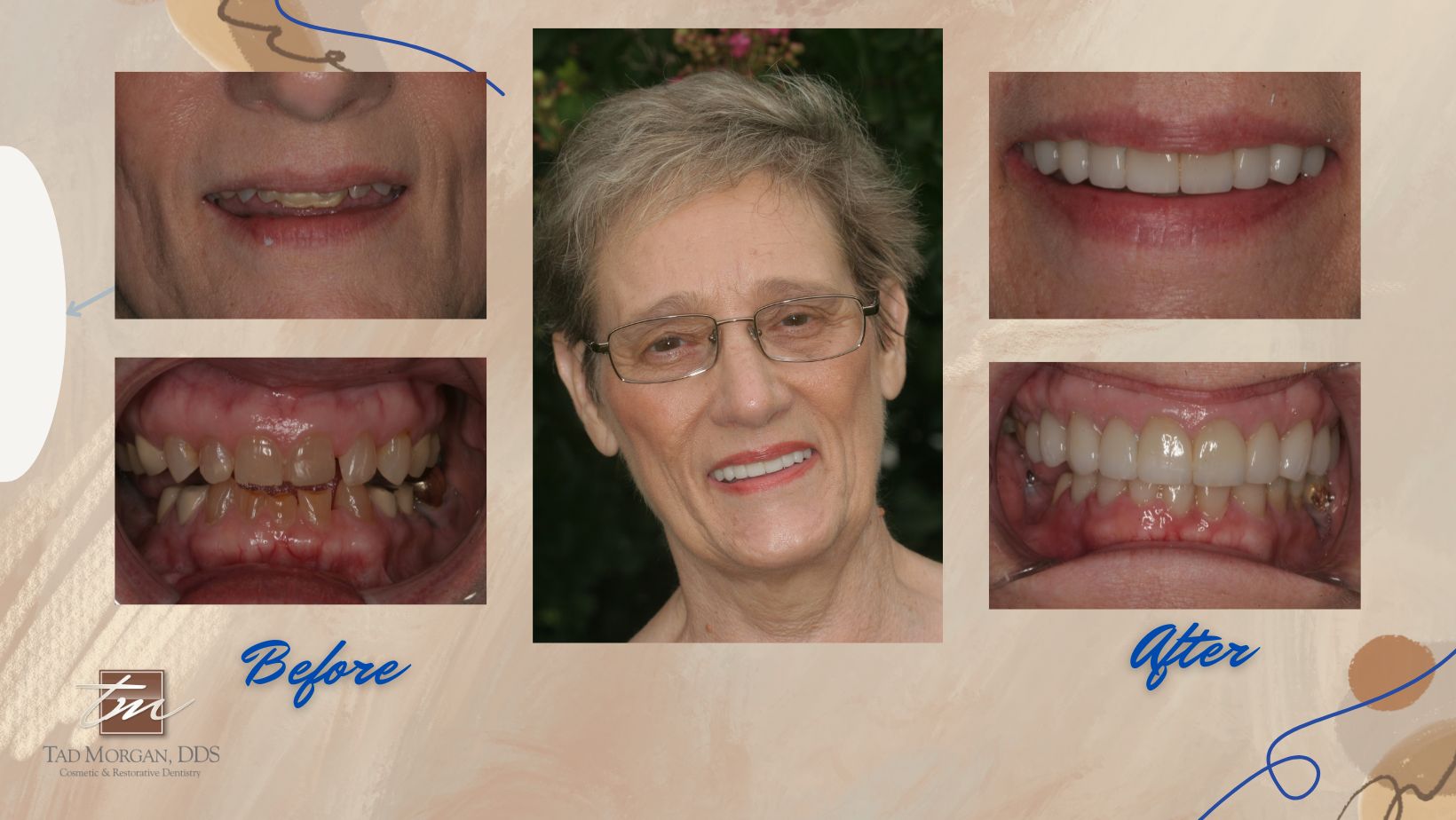Before and after photos of a woman's teeth.