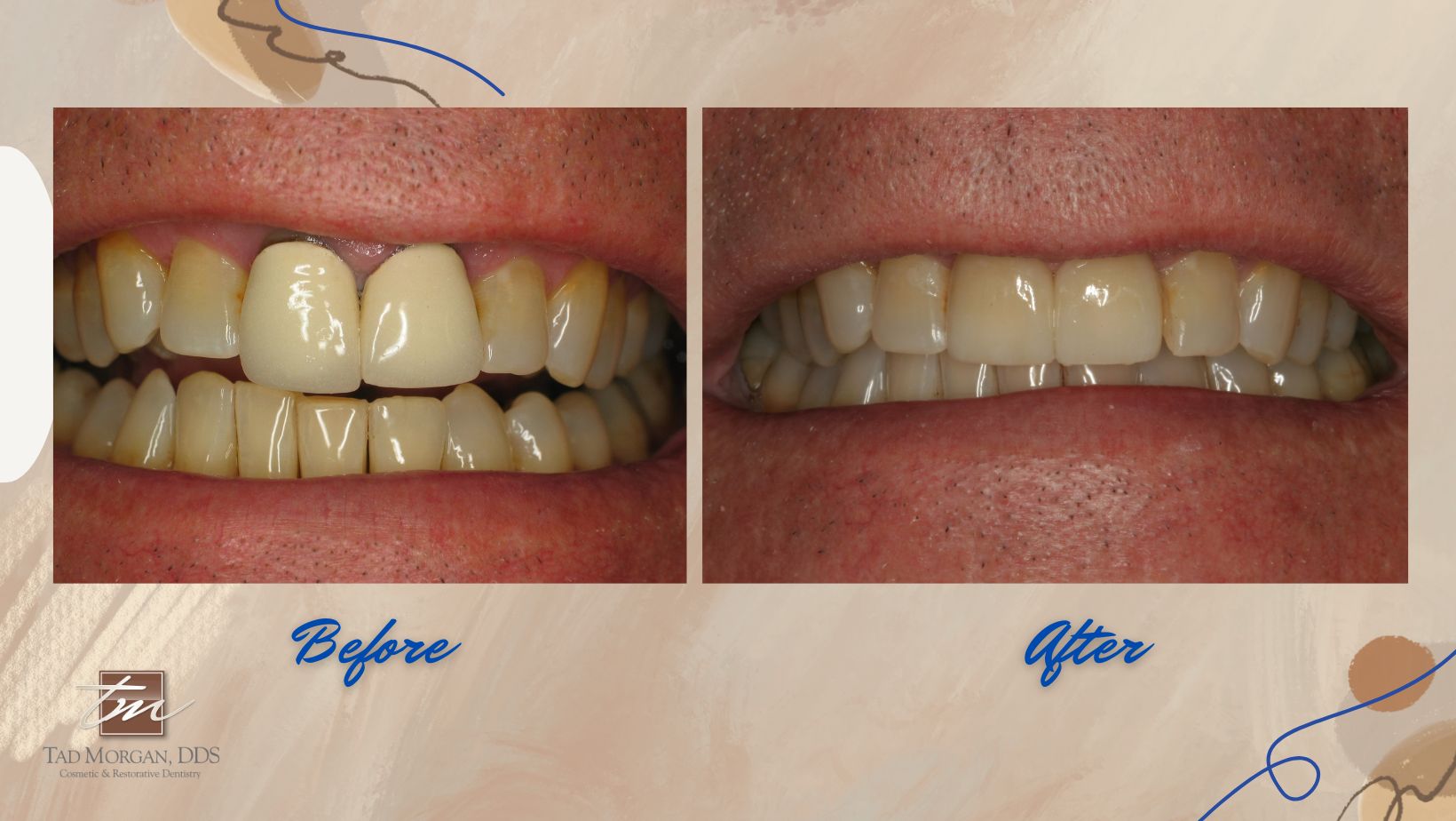 A man's teeth before and after dental veneers.
