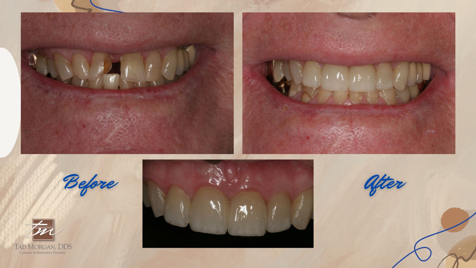 Before and after photos of a patient's teeth.