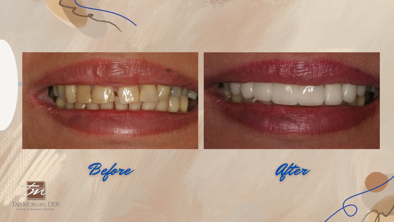 A woman's teeth before and after dental veneers.